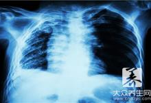 早期肺癌能100%治愈吗