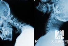 颈椎第一节凸出怎么办